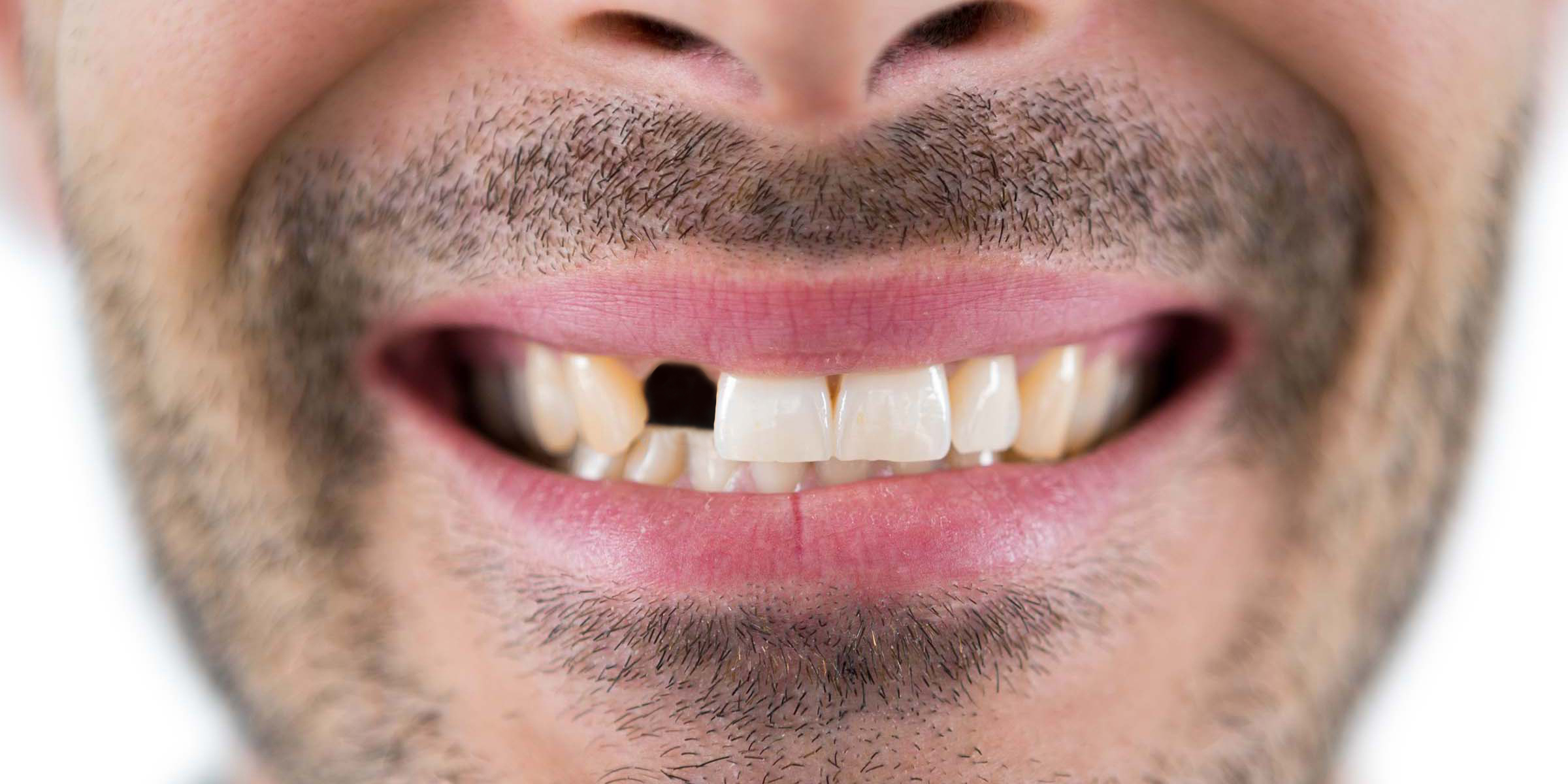 Man showing his teeth